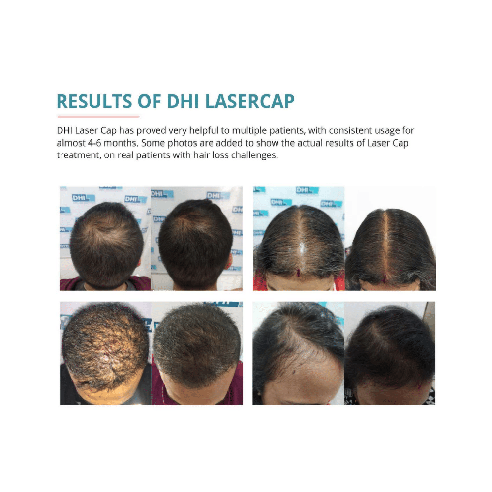 DHI Laser Cap with 272 Laser Diodes  FDA Approved & Clinically Proven for Hair Regrowth In Men & Women - Image 7