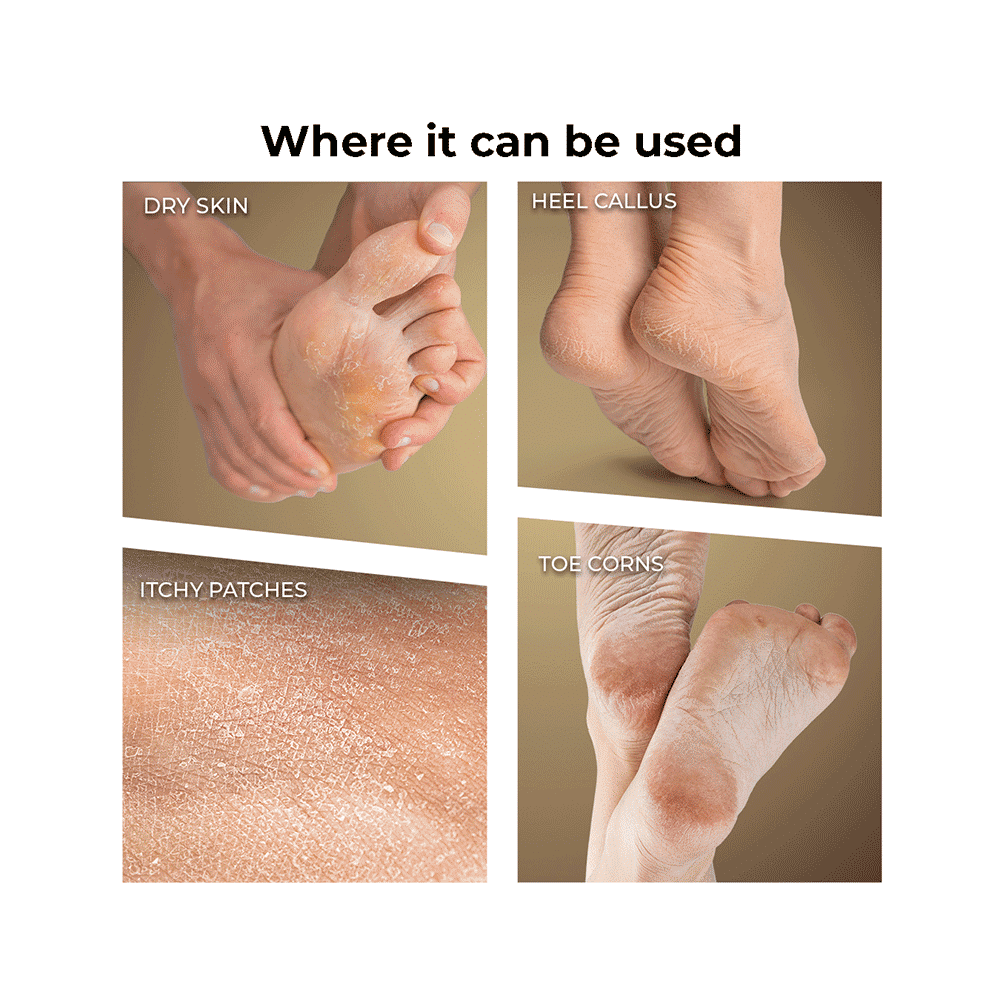 Winston Callus Remover - Image 3