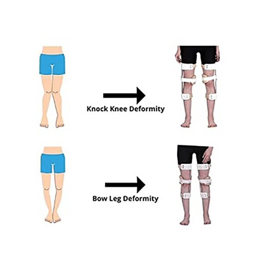 Salo Orthotics Knee Genu Valgum Varum Knock Knee & Bow Leg Brace Pair Size 15 - Image 4