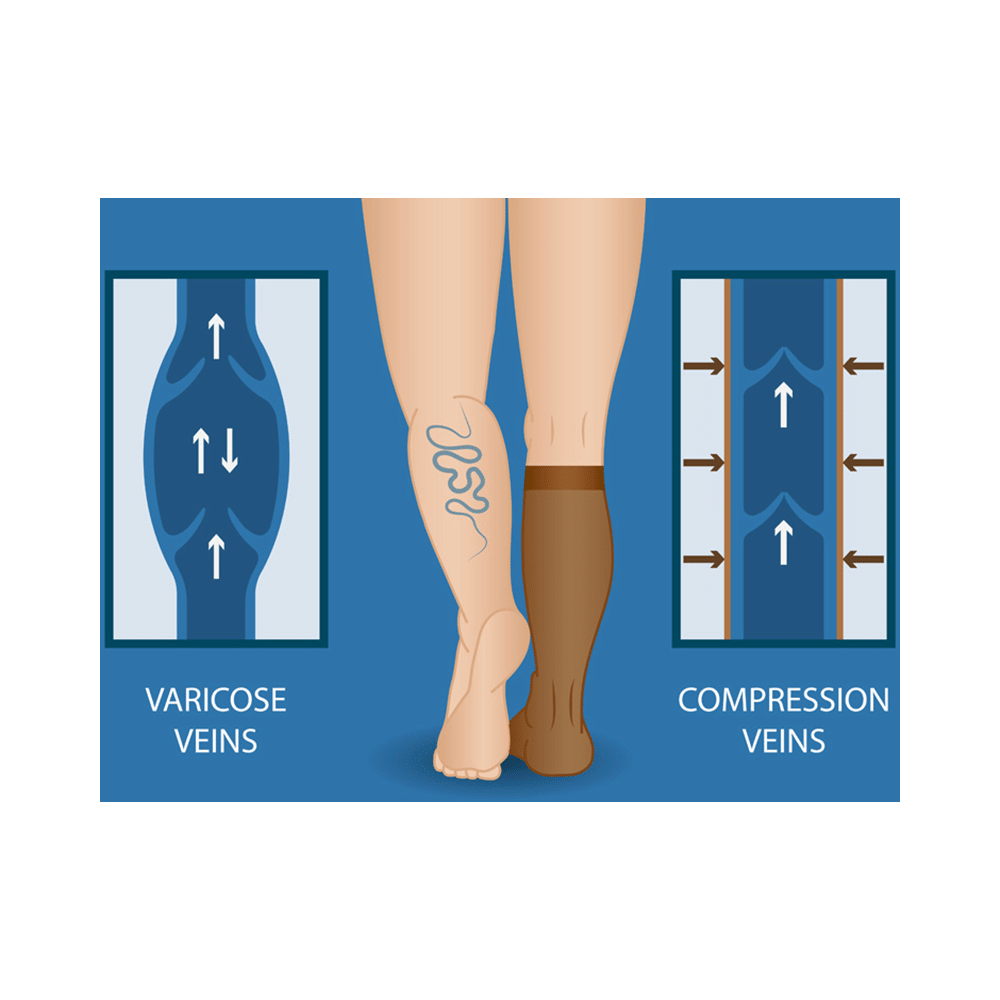 BN-VARICO 100 Medical Compression Stockings Theigh Length Beige XL - Image 4