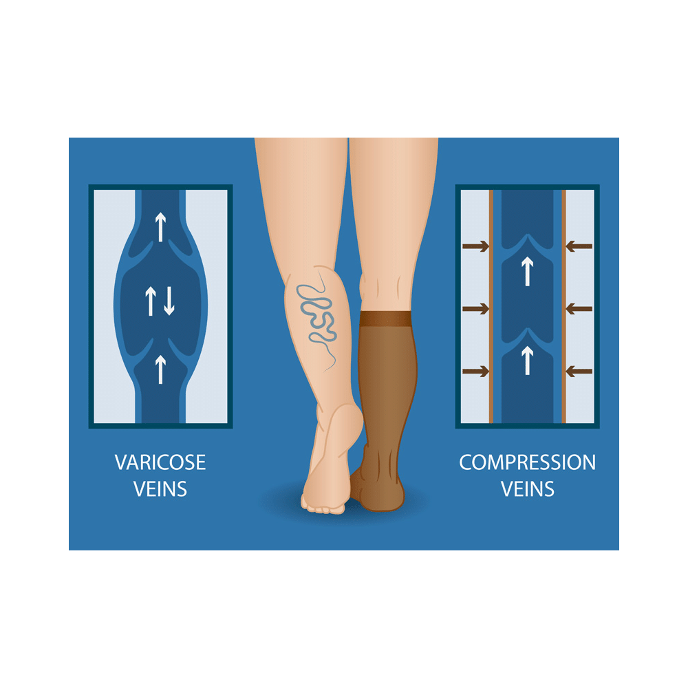 BN-VARICO 6000 Medical Compression Stockings Classic Thigh Length Beige Medium - Image 3