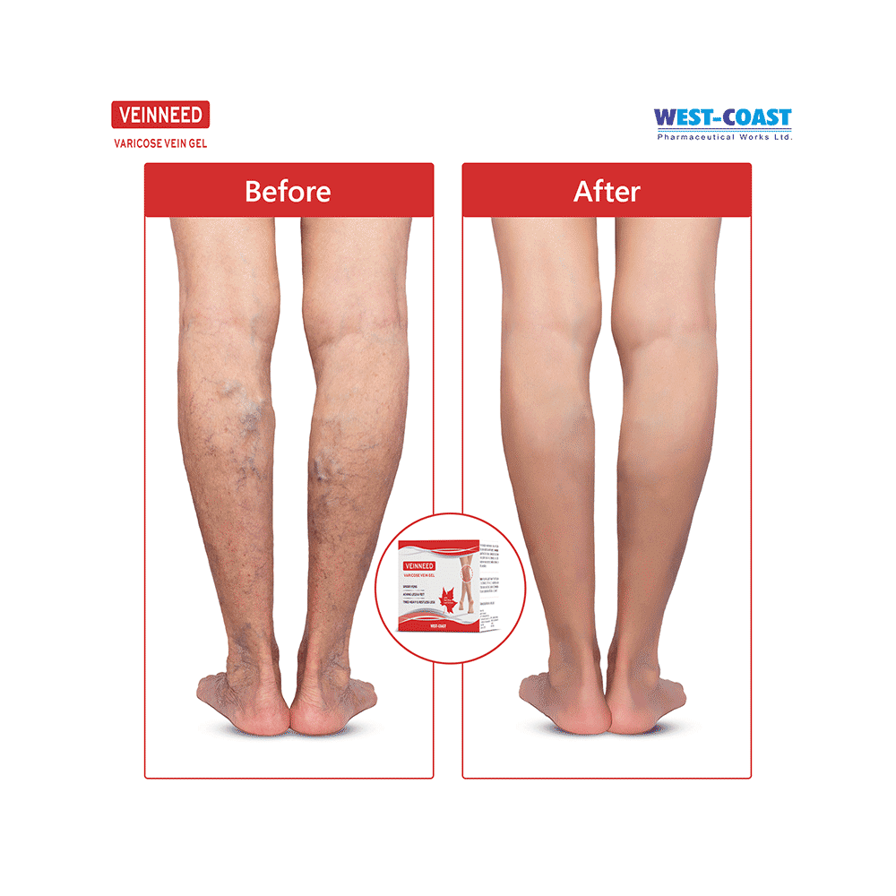 Veinneed Varicose Vein Gel - Image 10